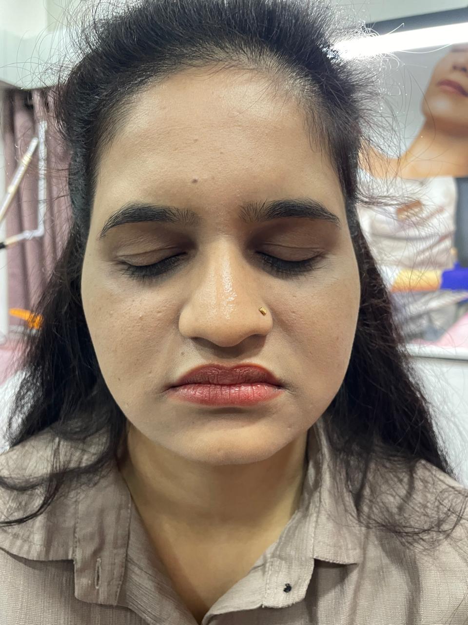 After - Under Eye Hollowness Filling